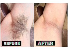 メンズスリーナインサロン(Men's ThreeNines Salon)/脇脱毛
