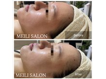 メイリー(MEILI)/光フェイシャル直後効果