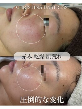 ココリール/赤み・乾燥肌