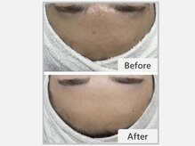 エマクラン(emmaclan)/