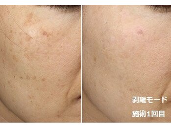 ナチュレアンドメディカ(Nature&Medica)/シミ集中ケア(Wフェイシャル)