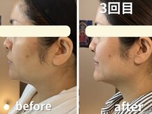 カルナー 武蔵小杉/回数毎に変化していく小顔エステ