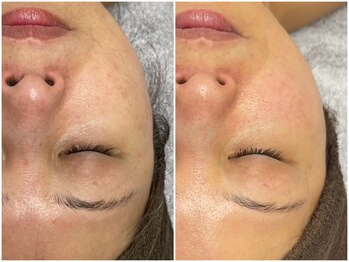 サロン ド グレース(Salon de Grace)/透明感くすみ知らずの肌へ