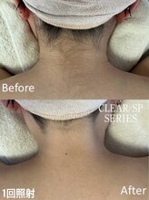 アンダンテ(Andante)/うなじ(襟足)脱毛