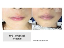 サロン ド メタセコイア(salon de Metasequoia)/【ジュニア脱毛】before／after