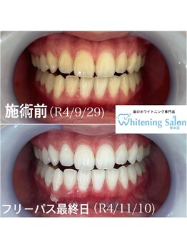 ホワイトニングサロン 熊本店/簡単ホワイトニング