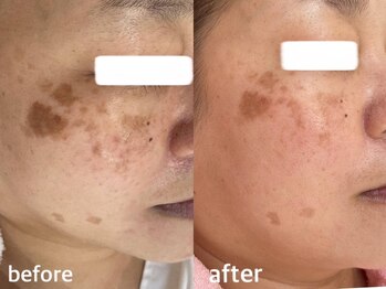 サクラ 伊勢原店(SAKURA)/シミのお悩みの方へ。