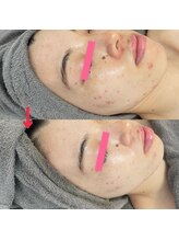 ダリア(Dahlia)/ハーブピーリング