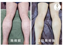 ヴォアール 名古屋店(VOIR)/メンズ脱毛　脚脱毛