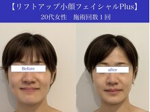 リプロ(RePro)/20代　ビフォーアフター