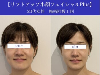 リプロ(RePro)/20代 ビフォーアフター