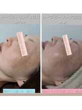 奏美/ハーブピーリング