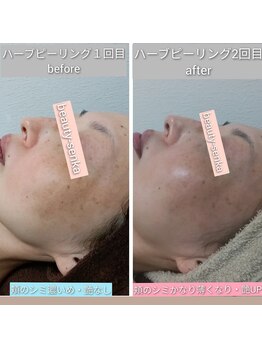 奏美/ハーブピーリング