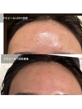 シャンディ(Shandy)/ラミピールはニキビケアにも◎