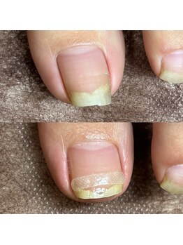 リリ(lili)/巻き爪矯正/1回目/左親指巻き爪