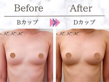 メディカルサロン エム エム エム 大阪梅田グランドサロン(M.M.M)/【バストアップ例】　B→Dカップ