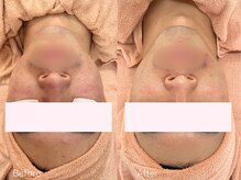 ミュー 自由が丘店(mieux)/◆肌質改善例