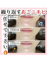 ホワイトアクア 天王寺本店(WHITE AQUA)/ハーブピーリング/大阪/天王寺