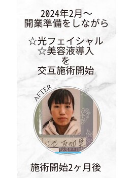 ひなた(salon)/フェイシャル施術2ヶ月後