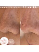 アンテイン チル(anthein chill)/毛穴のお掃除フェイシャル