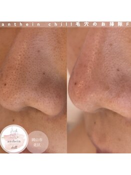 アンテイン チル(anthein chill)/毛穴のお掃除フェイシャル