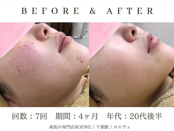 ロエヴェ(ROEWE)/ニキビ改善・毛穴ケア・肌質改善