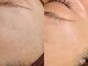 ピグレ(Pigrer)の写真/お顔のくすみ、産毛かも？フェイシャルワックスでお肌をワントーン明るく！きれいな素肌を手に入れよう♪