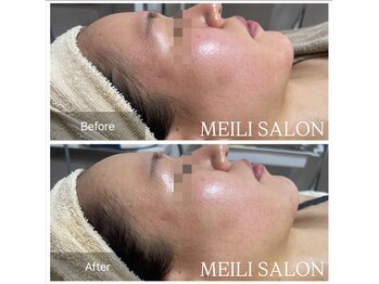 メイリー(MEILI)/光フェイシャル直後効果