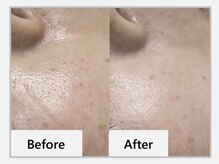 エマクラン(emmaclan)/