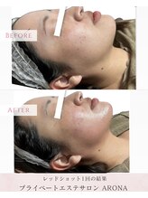 アローナ(ARONA)/韓国から上陸！レッドショット！