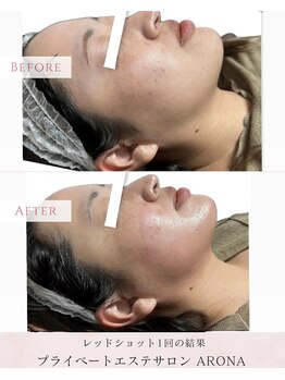 アローナ(ARONA)/韓国から上陸！レッドショット！