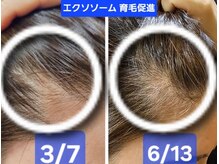 アン 銀座(ann)/エクソソーム育毛促進
