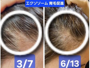アン 銀座(ann)/エクソソーム育毛促進