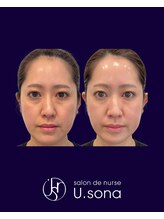 小顔・脂肪コントロール専門 salon de nurse U.sona～松本店～/【韓国基礎化粧品で艶ハリ爆弾】