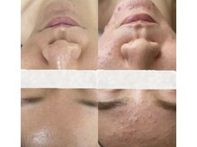 徹底ニキビケア◎繰り返す肌トラブルに！肌質改善でもう悩まない