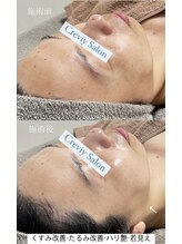 クレヴィー(Creviy)/最先端の細胞美容成分コース