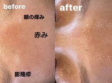 リノアンド(Lino&)/痒みや赤みの鎮静