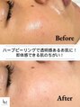 ベル 調布(Belle)&nbsp;1回でお肌 白玉肌★