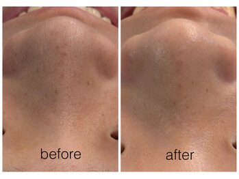 ハリスキンラボ(Hari.Skin.Lab)/10代のお客様/1回の施術効果