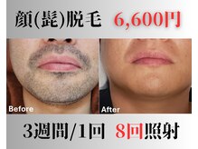 アップパイン(UPPINE)/顔(ヒゲ)脱毛¥3,300(初回価格)