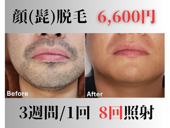 アップパイン(UPPINE)/顔(ヒゲ)脱毛¥3,300(初回価格)