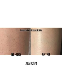 ファウラ(faura:)/膝下(表)脱毛