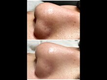 ユジュ(yju)/毛穴　美白