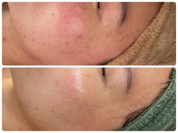 ベル(Bell)/ハーブピーリングとフォト