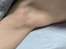 フォーグッド(forgood)の雰囲気(男性のワキ脱毛/早く終わらせたい/痛みに弱い方オススメ)