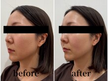 たたら鍼灸整骨院/40代女性 &nbsp;before / after