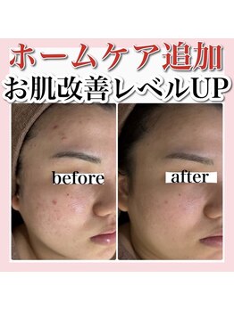 アルムダアクア 天王寺店(Aleumda AQUA)/ハーブピーリング/大阪/天王寺