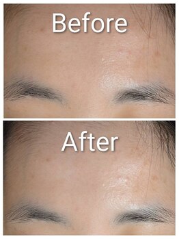 ミヨン ヨコハマ(Miyonne Yokohama)/LDM Aqua+小顔ヘッドスパ上大岡