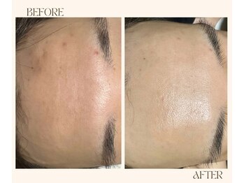 レヴ 都城店(rev)/おでこからツヤ肌に!