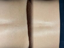 グラスト(Grast)/背中脱毛・福岡/大橋/天神/博多